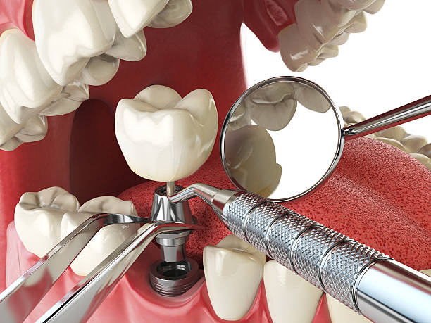 Best Emergency Root Canal Treatment in Tracyton, WA